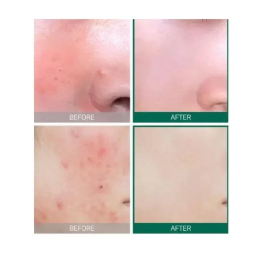 SOME BY MI AHA-BHA-PHA 30 days Miracle Serum 50 ml - Image 5